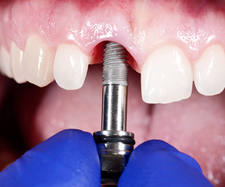 Dr. François Maschino - Extraction dents de sagesse, implants dentaires ...