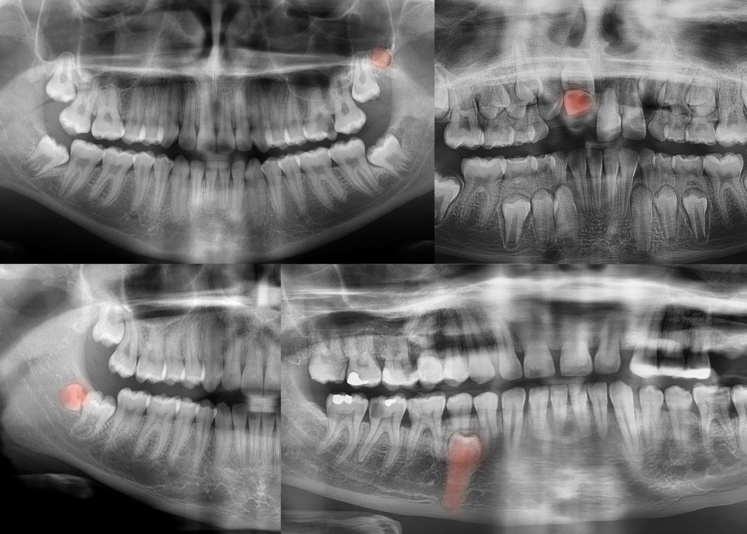Dr François Maschino - Extraction dents surnuméraires Paray-le-Monial