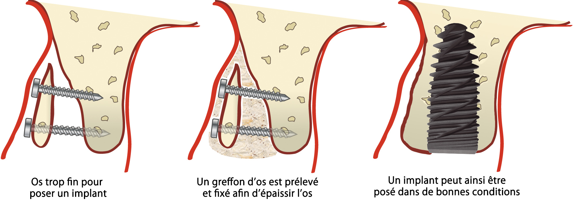 Dr Fançois Maschino - Greffes osseuses - Implants