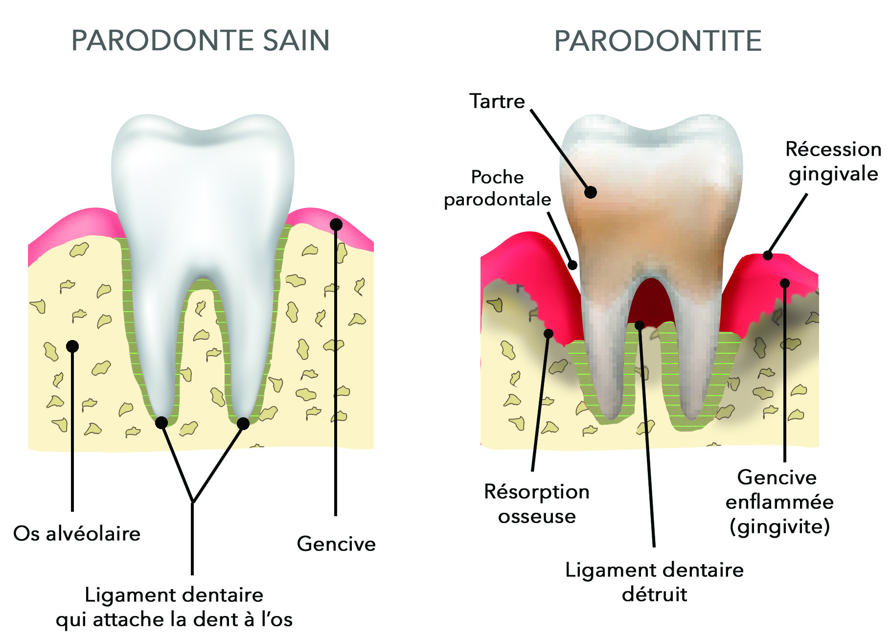 Dr François Maschino - Parodonte sain & Parodontite